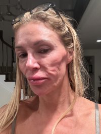 Brandi Glanville Celebrates Holidays In 1st Public Appearance Amid Face Parasite Battles